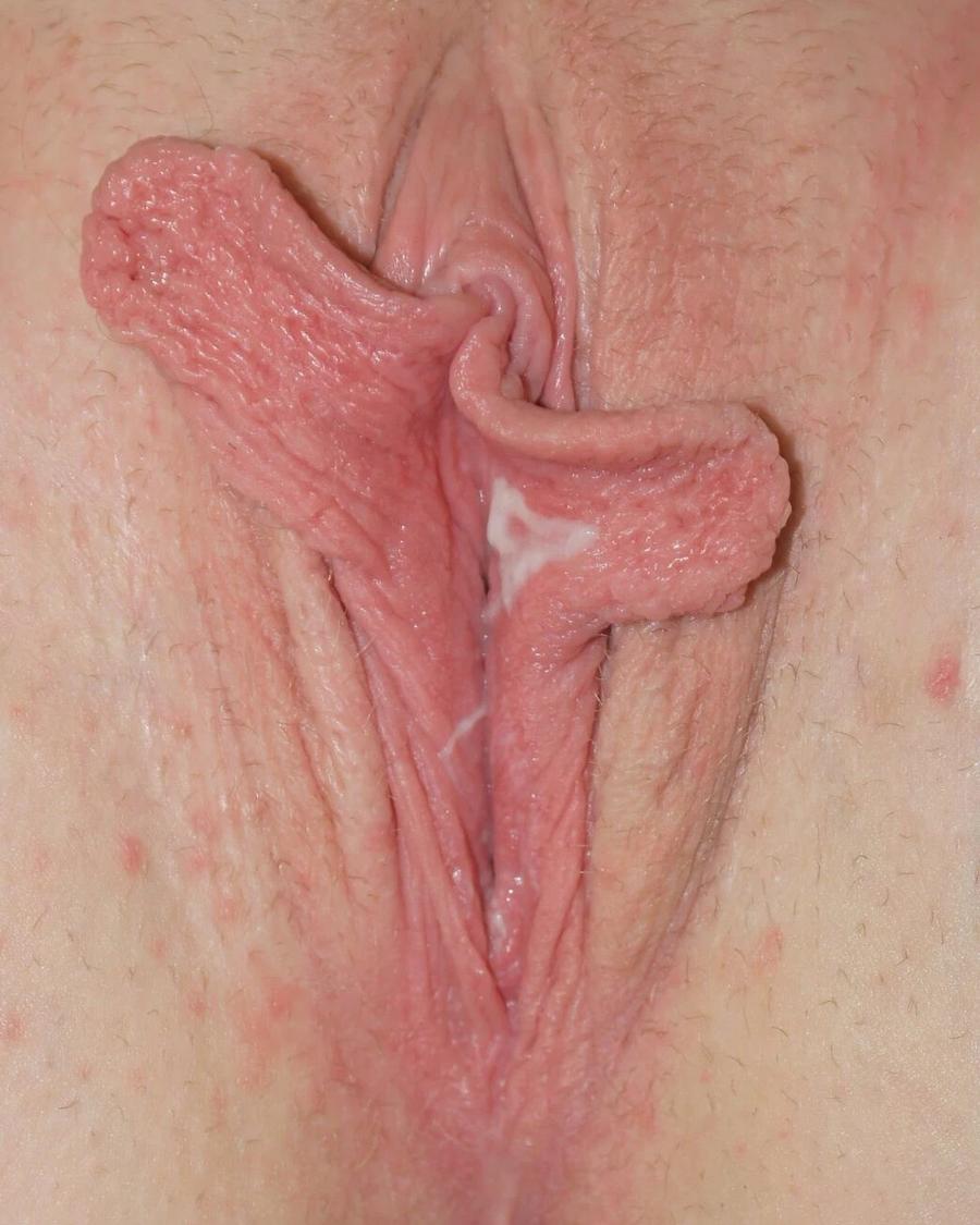 Labiaplasty before