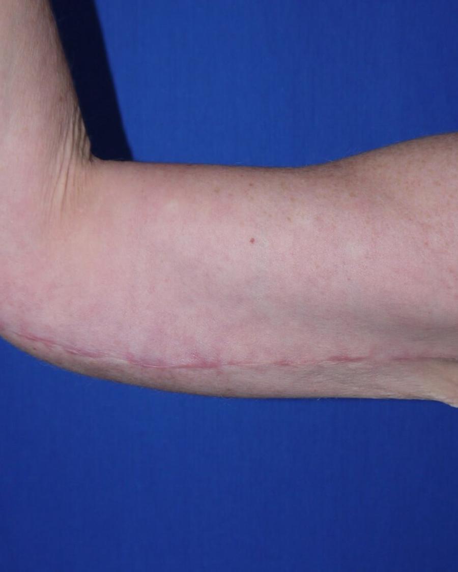 Arm Lift after