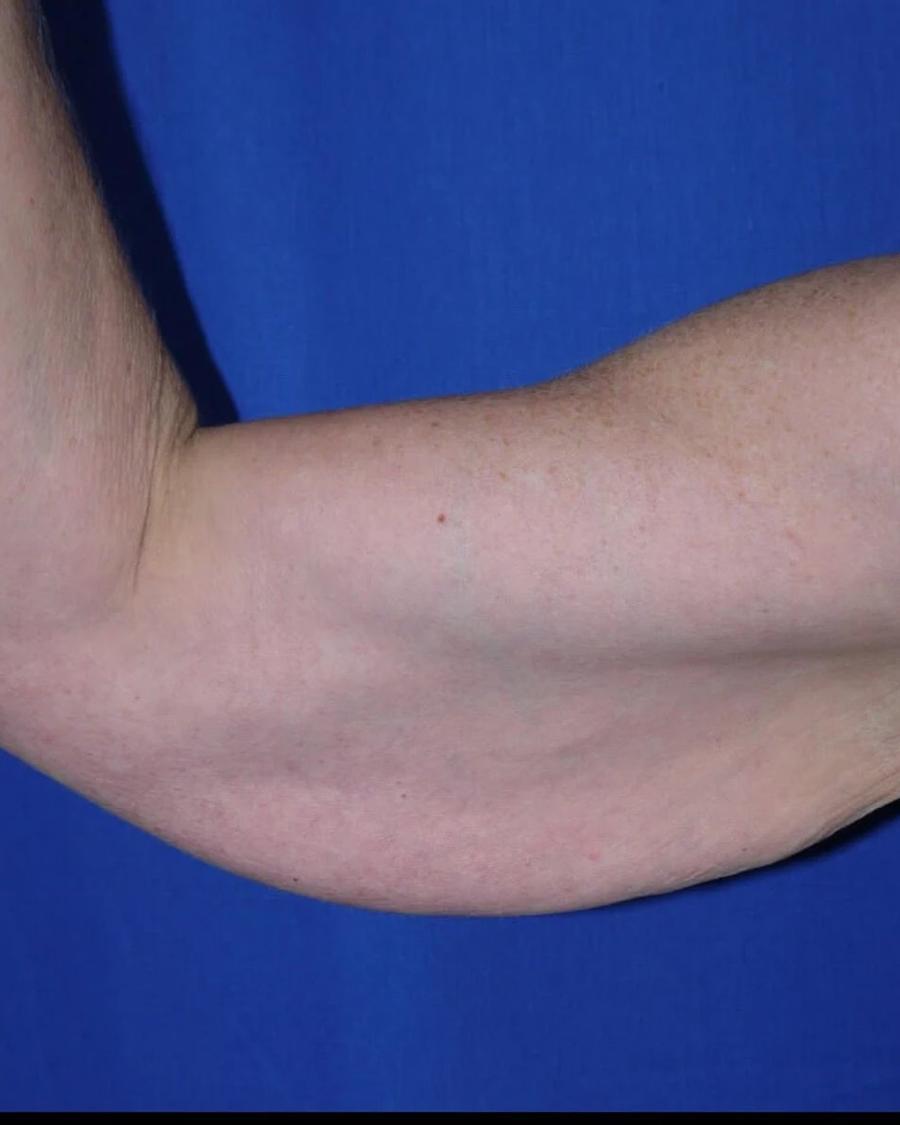 Arm Lift before