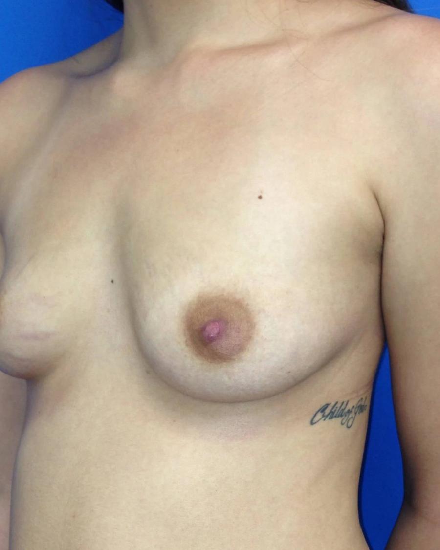Breast Augmentation with Implants before
