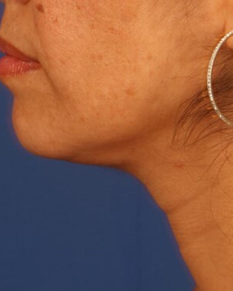 Neck Liposuction w/ Magic Tight after