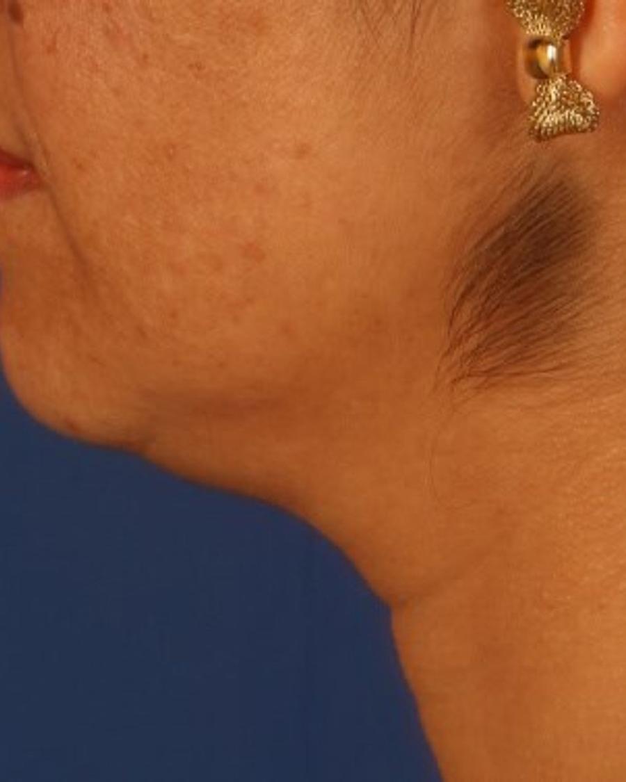 Neck Liposuction w/ Magic Tight before