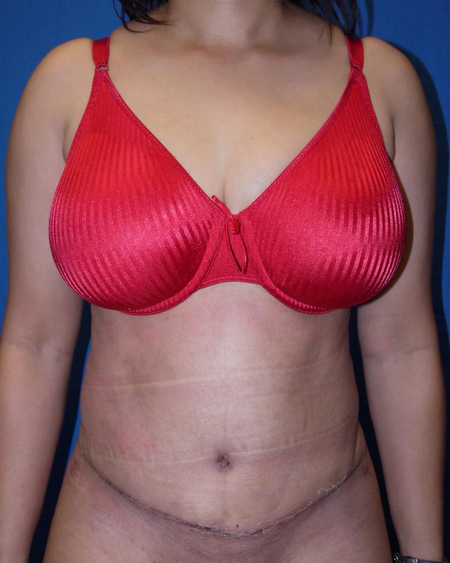 Tummy Tuck after