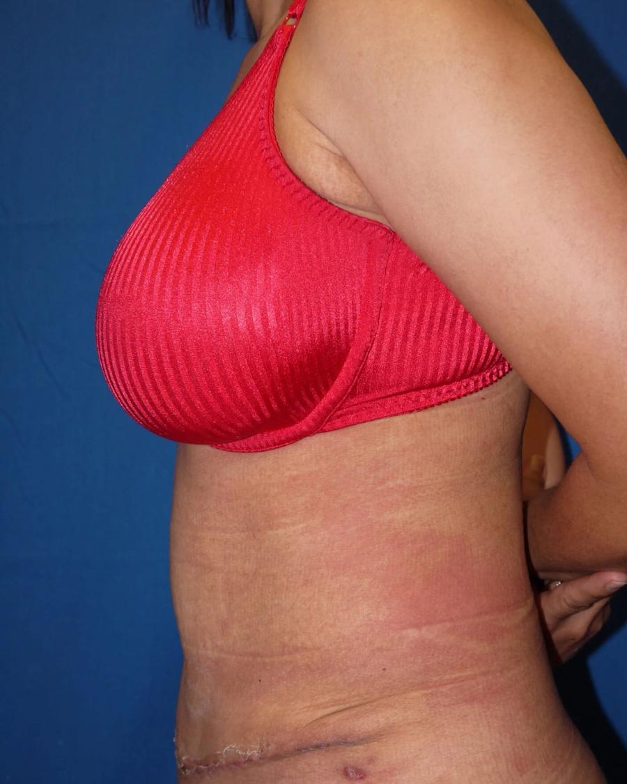 Tummy Tuck, Left Profile view, after