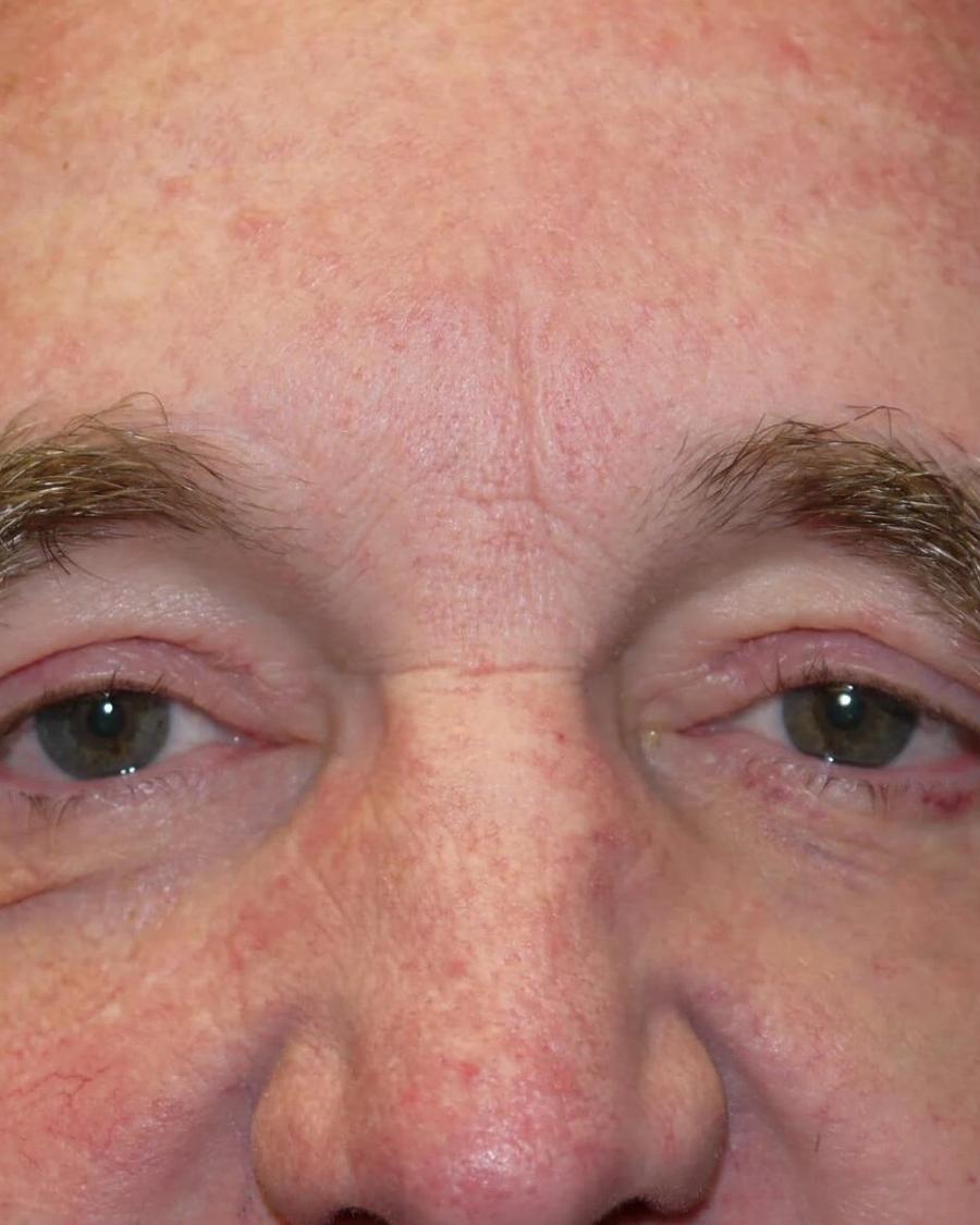 Eyelid Surgery after