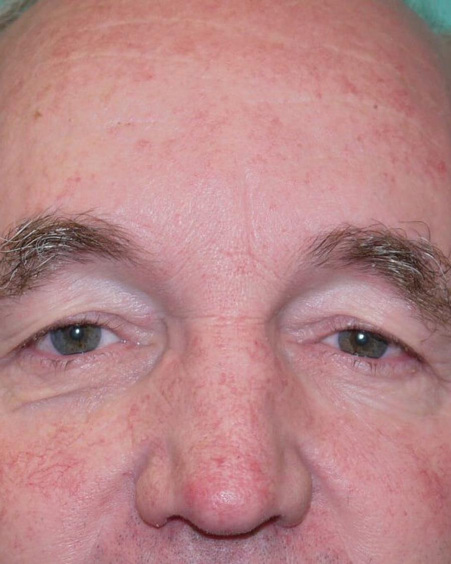 Eyelid Surgery before