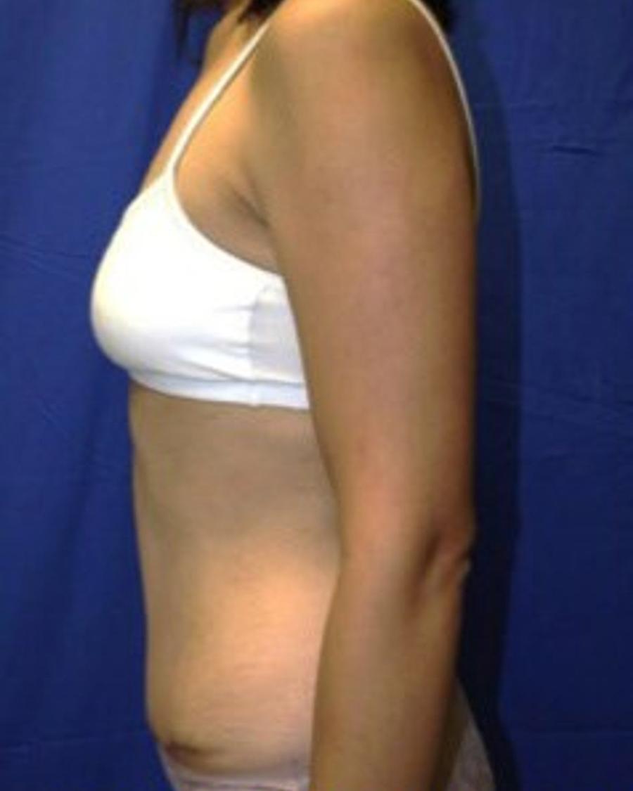 Tummy Tuck, Left Profile view, after