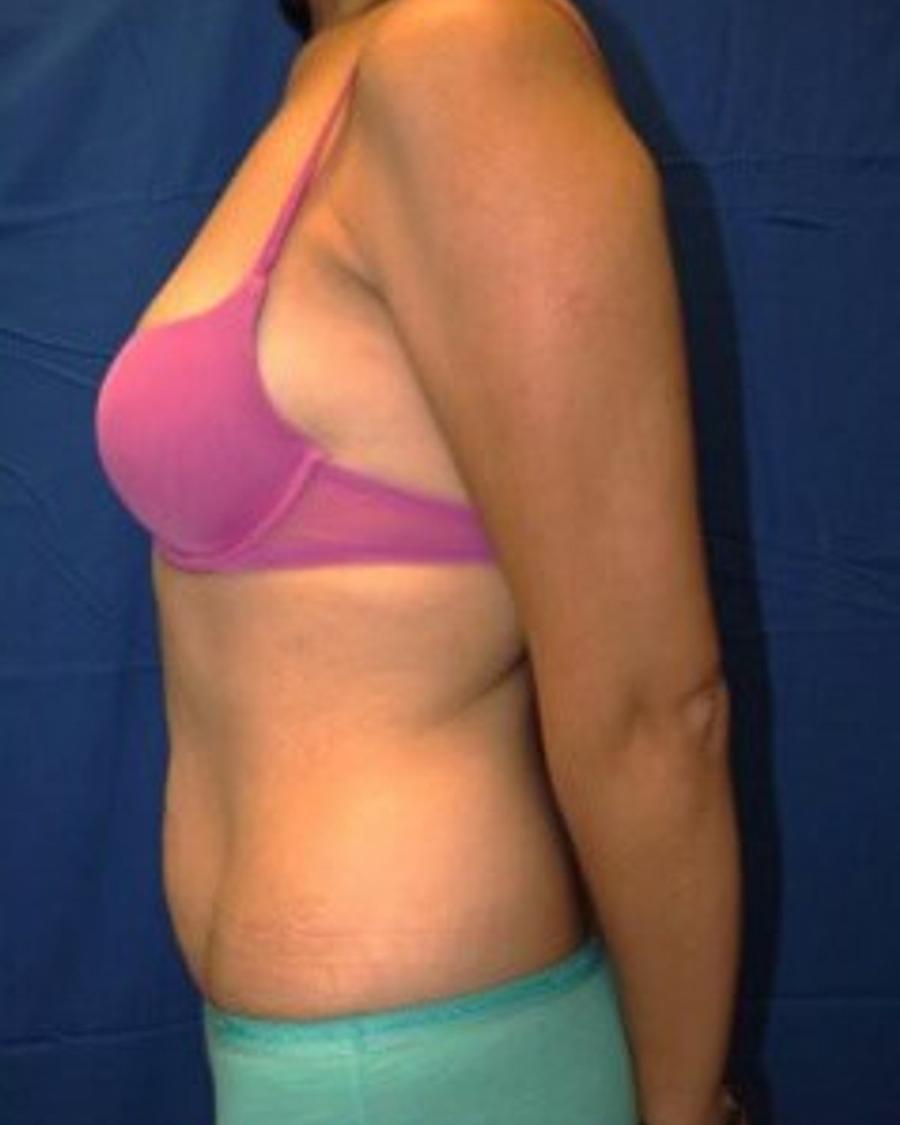 Tummy Tuck, Left Profile view, before