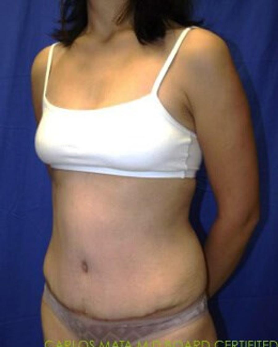 Tummy Tuck, Oblique Right view, after
