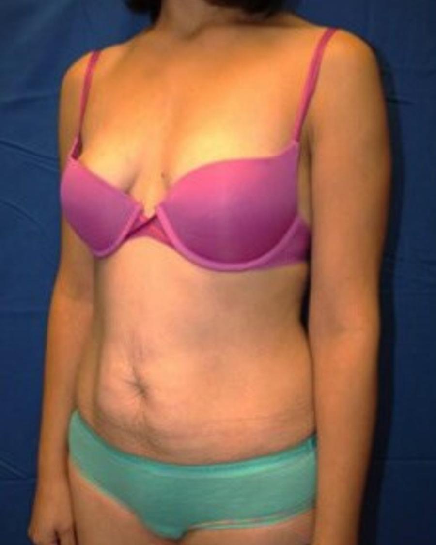 Tummy Tuck, Oblique Right view, before
