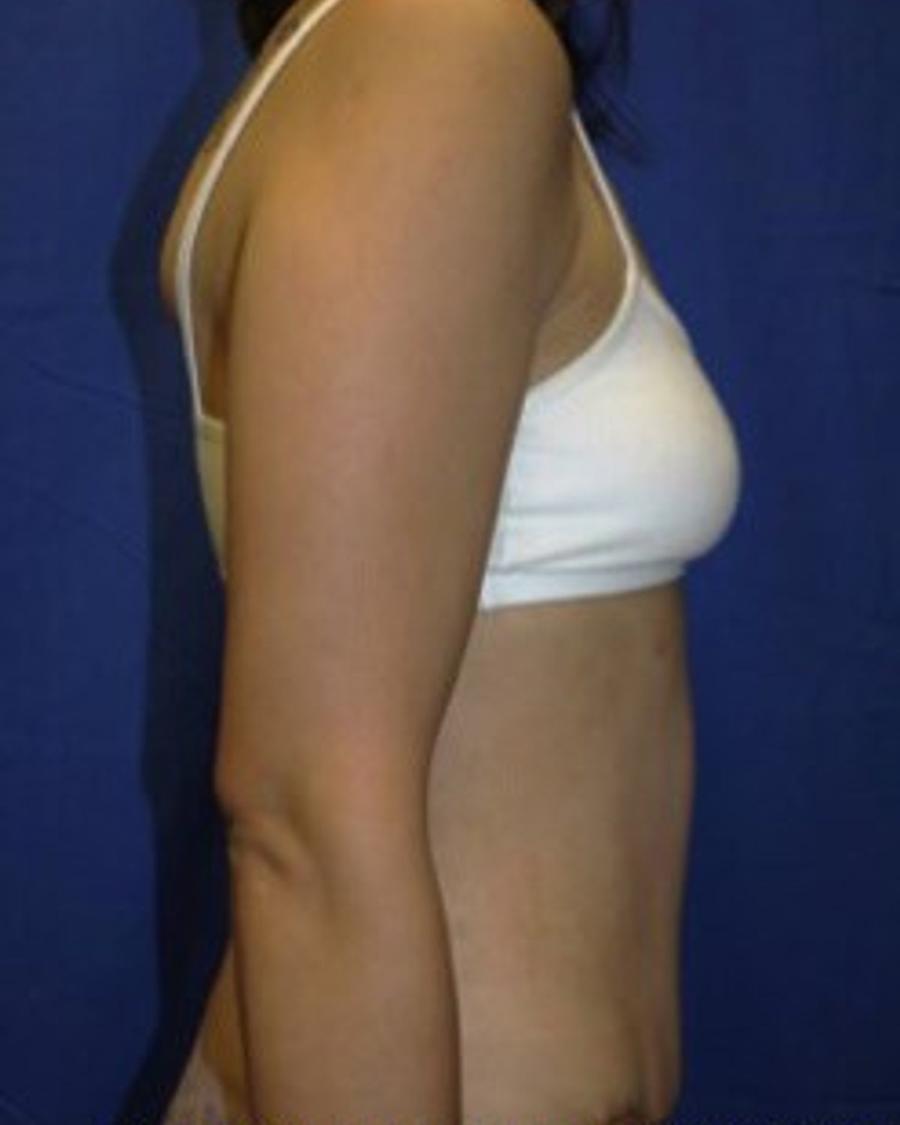 Tummy Tuck, Right Profile view, after