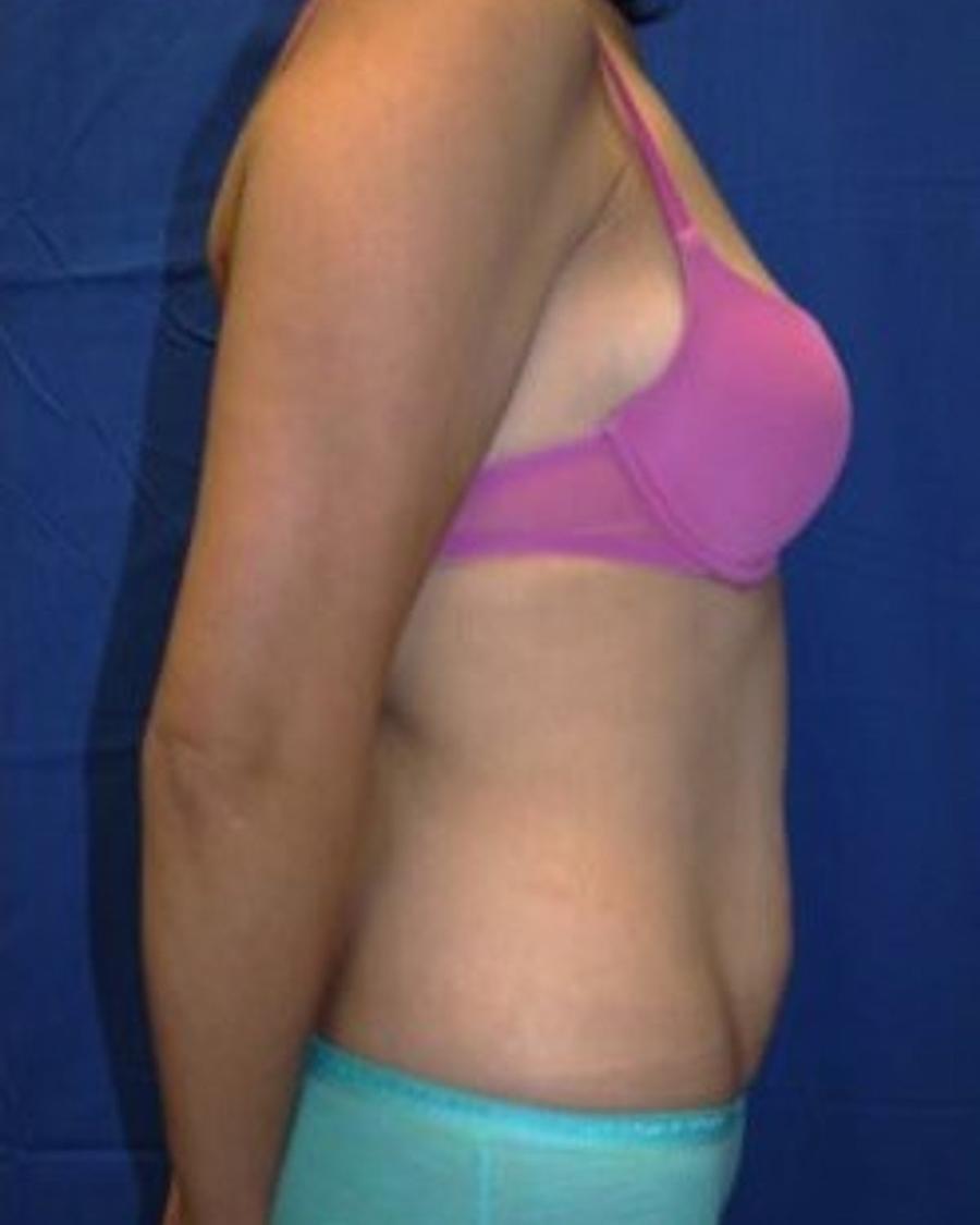 Tummy Tuck, Right Profile view, before