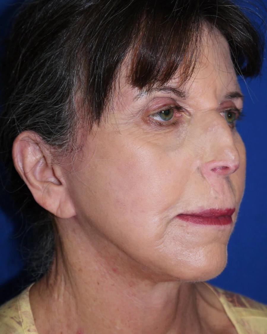 After Facelift (neck lift included)