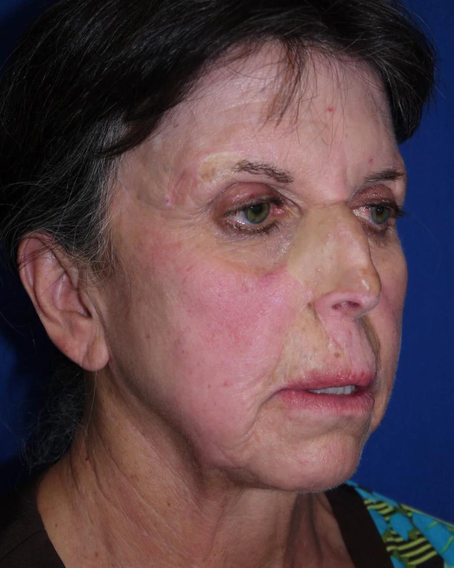 Before Facelift (neck lift included)