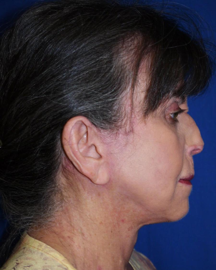 Facelift (neck lift included), Right Profile view, after