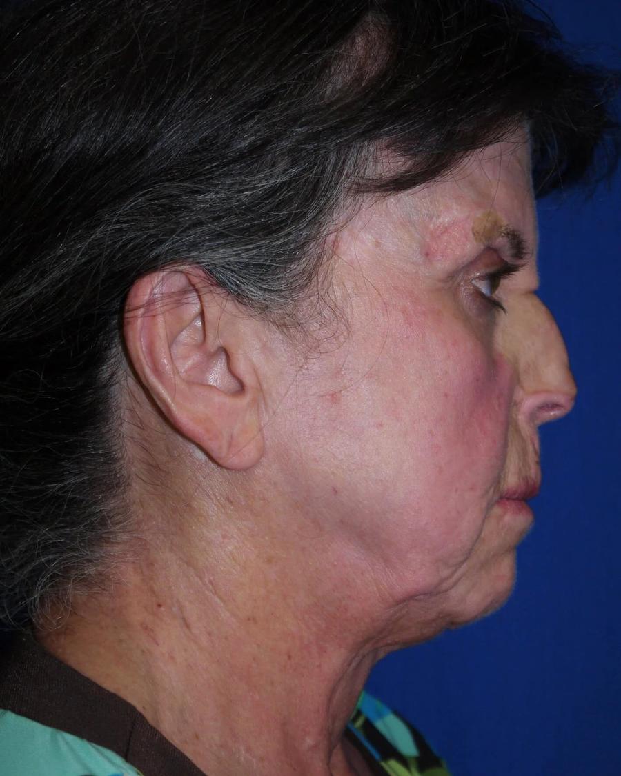Facelift (neck lift included), Right Profile view, before