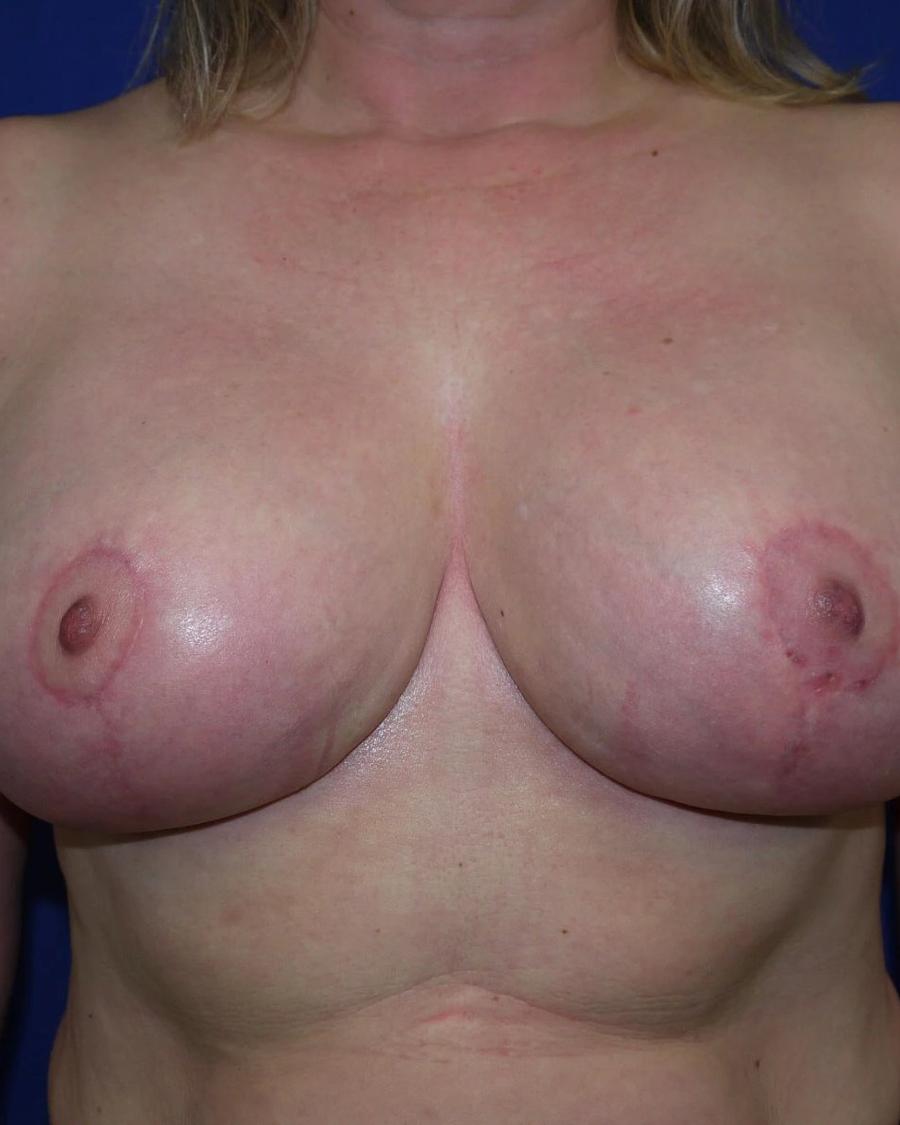 Breast Reduction after