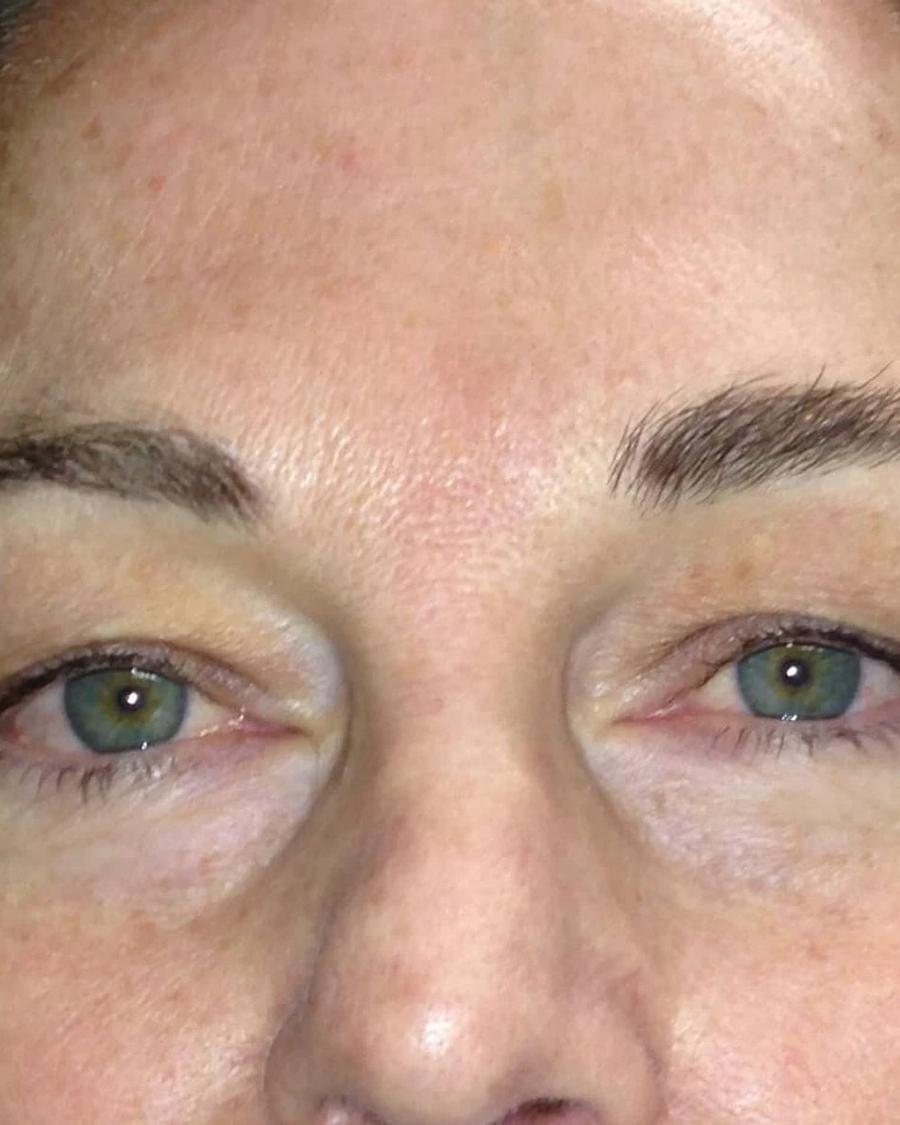 Before Eyelid Surgery