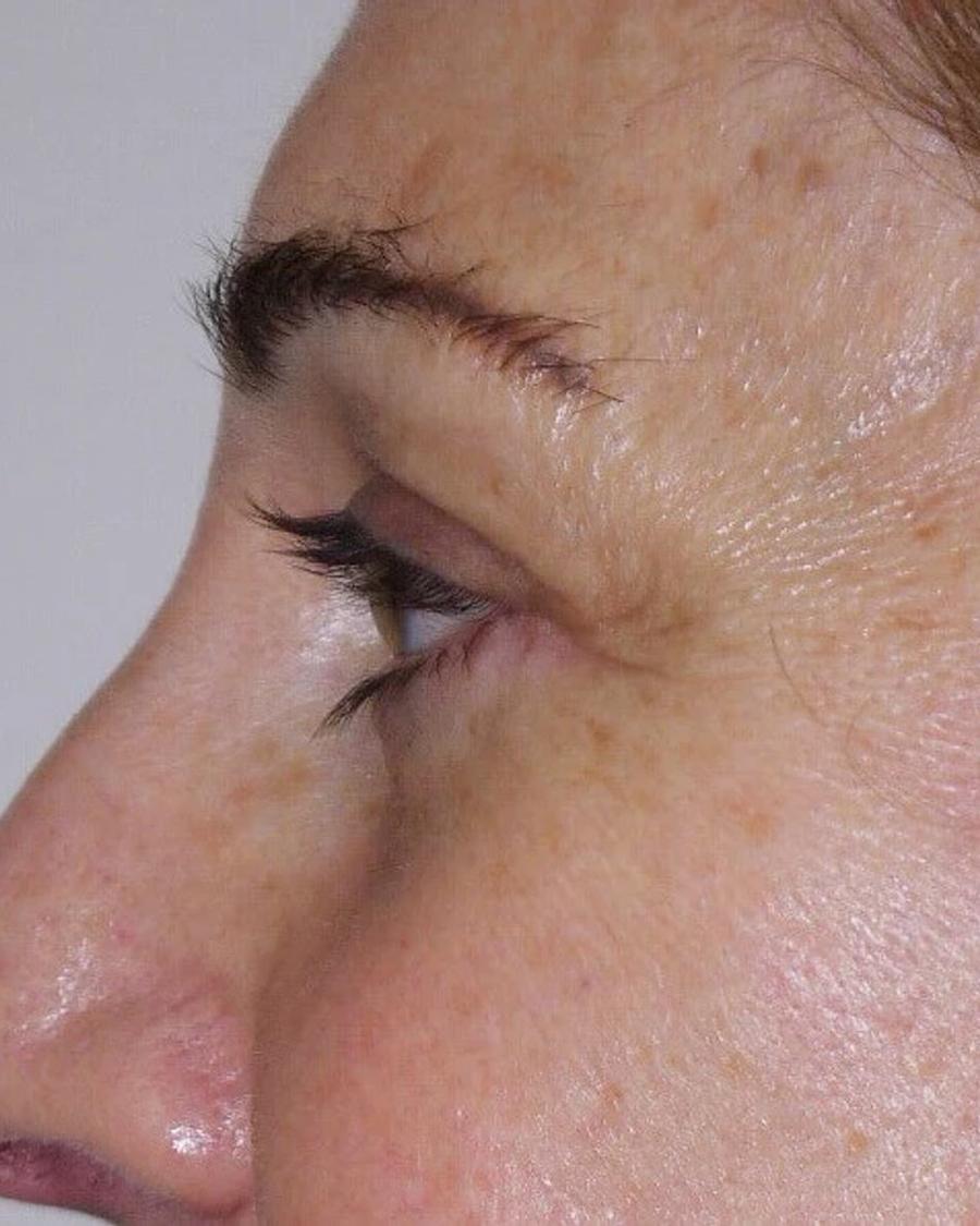 Eyelid Surgery, Oblique Left view, after