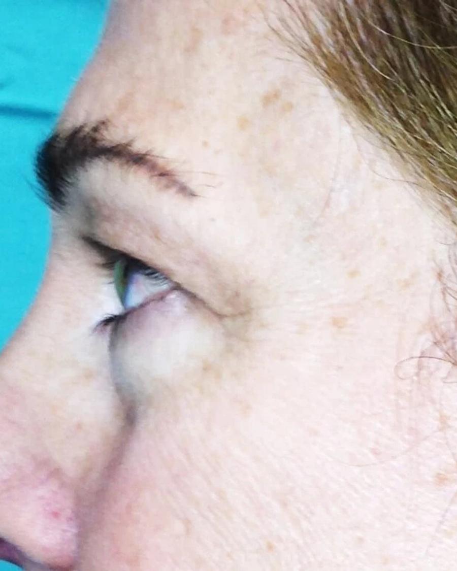 Eyelid Surgery, Oblique Left view, before