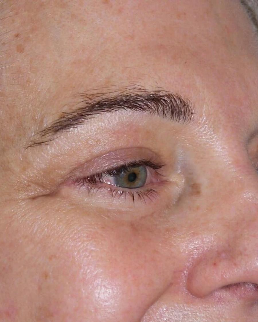 After Eyelid Surgery