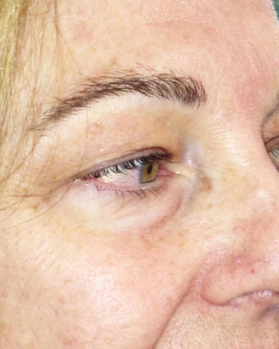 Before Eyelid Surgery