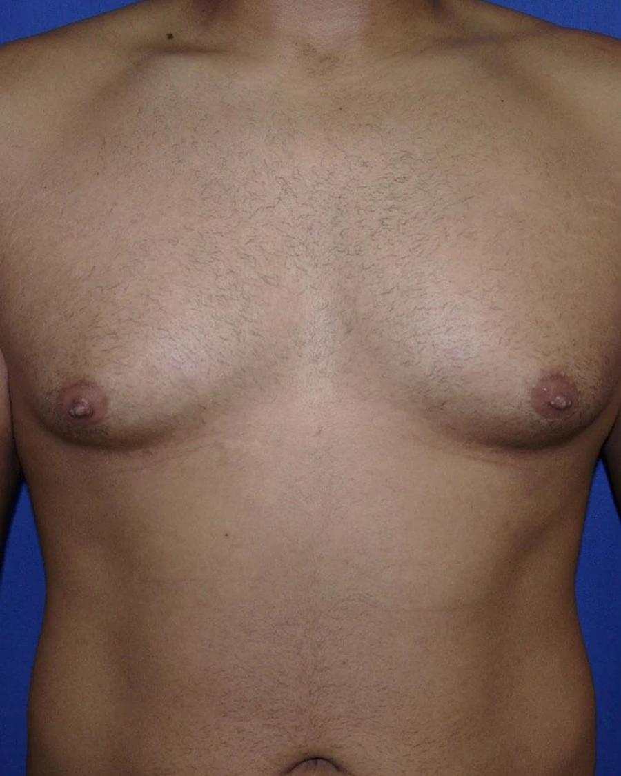 One-Stitch Gynecomastia before