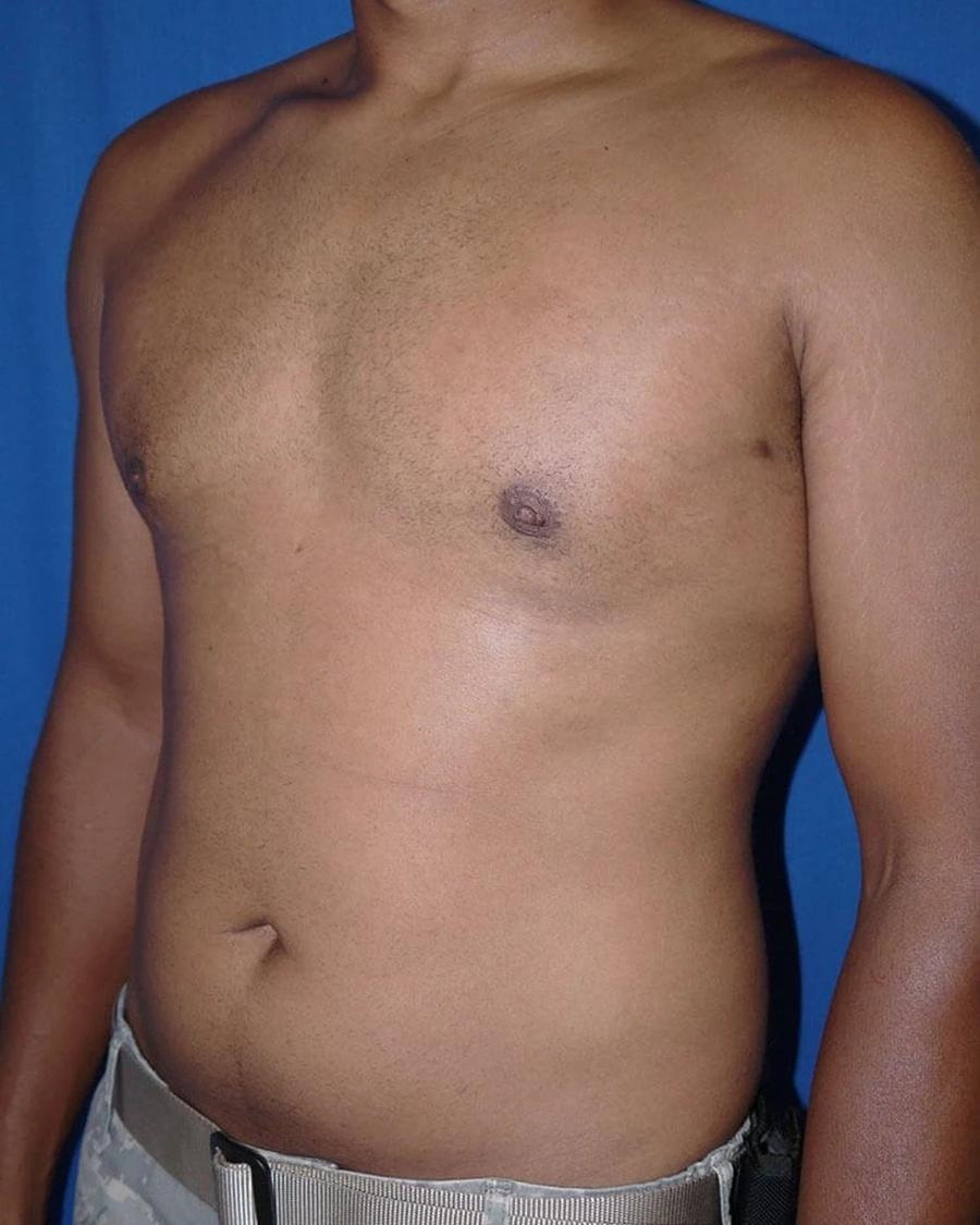 One-Stitch Gynecomastia, Oblique Right view, after