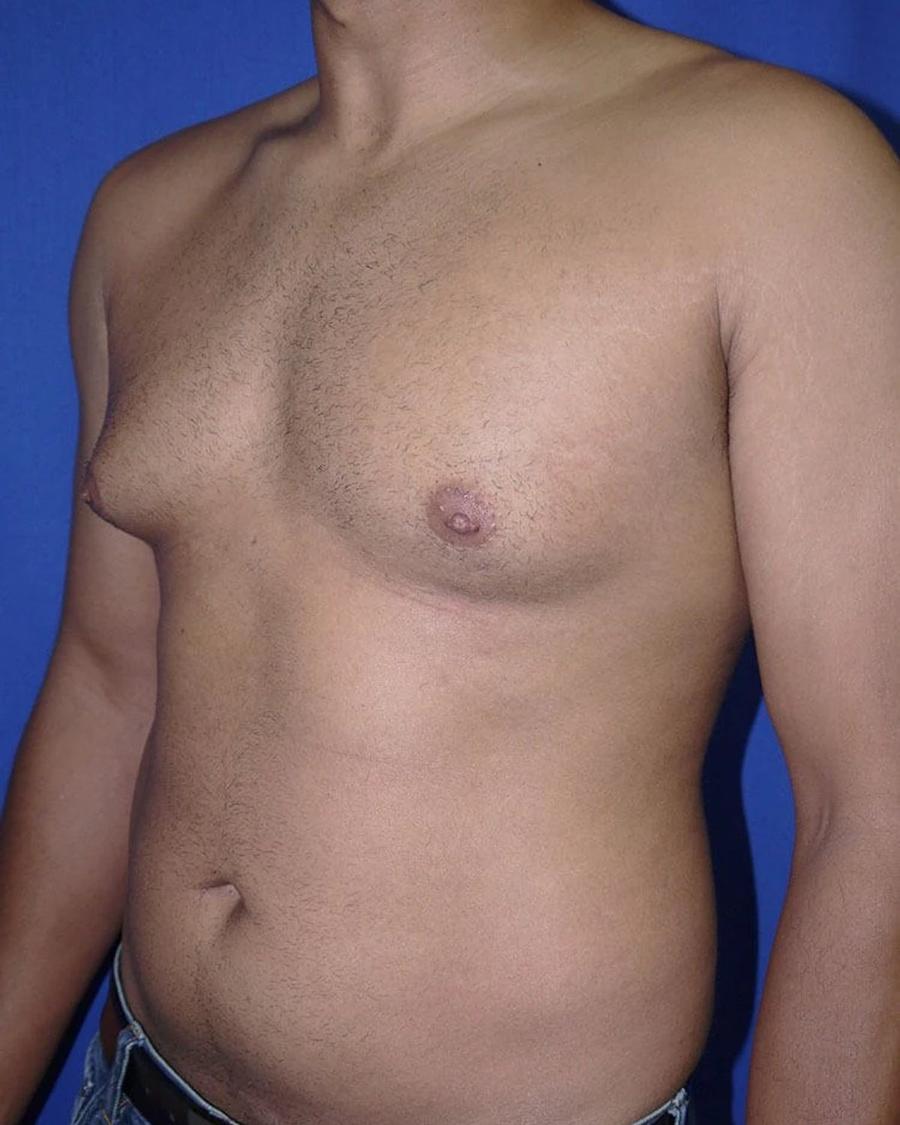 One-Stitch Gynecomastia, Oblique Right view, before