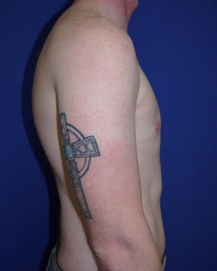 One-Stitch Gynecomastia, Right Profile view, after