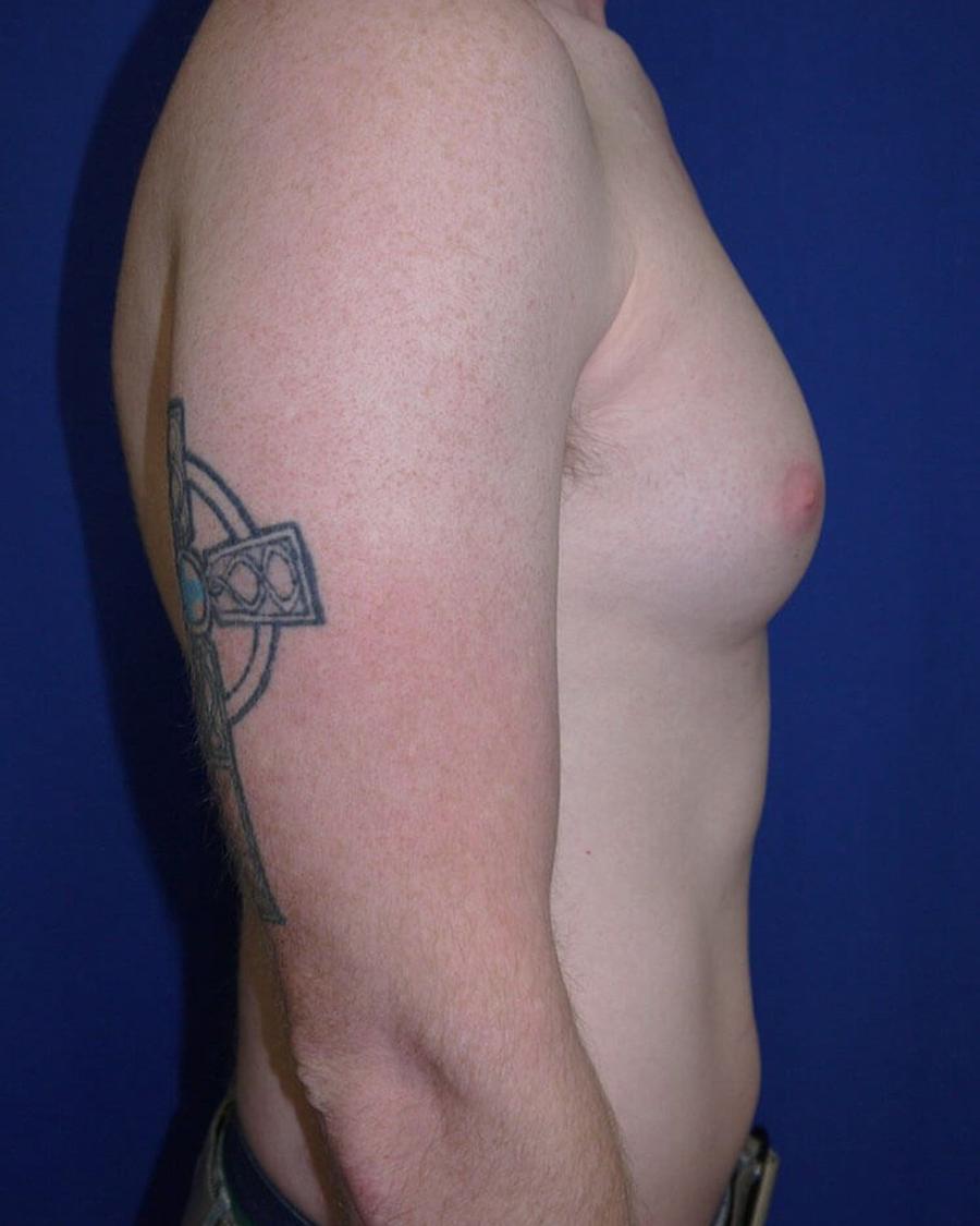 One-Stitch Gynecomastia, Right Profile view, before