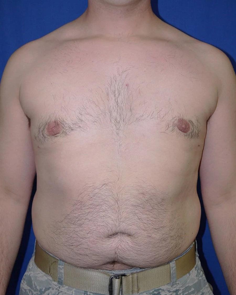One-Stitch Gynecomastia after