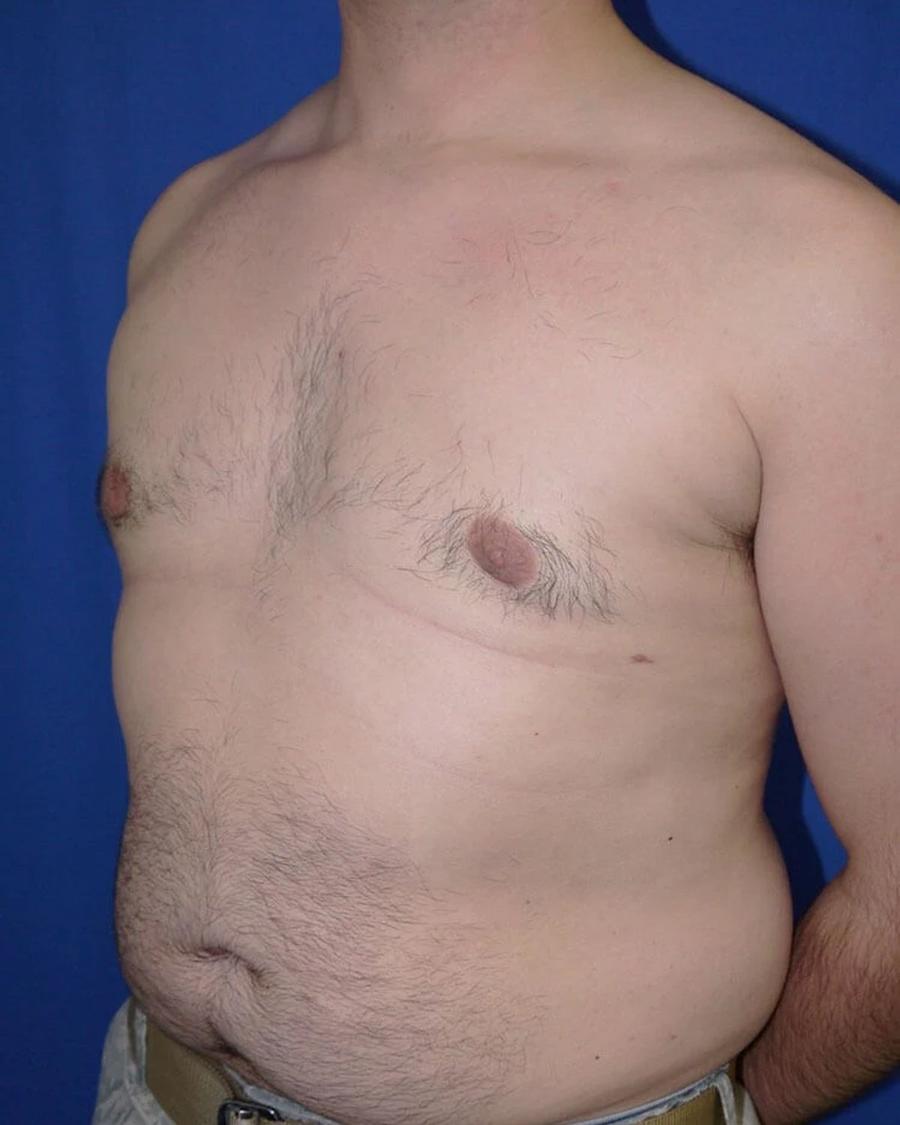 One-Stitch Gynecomastia after