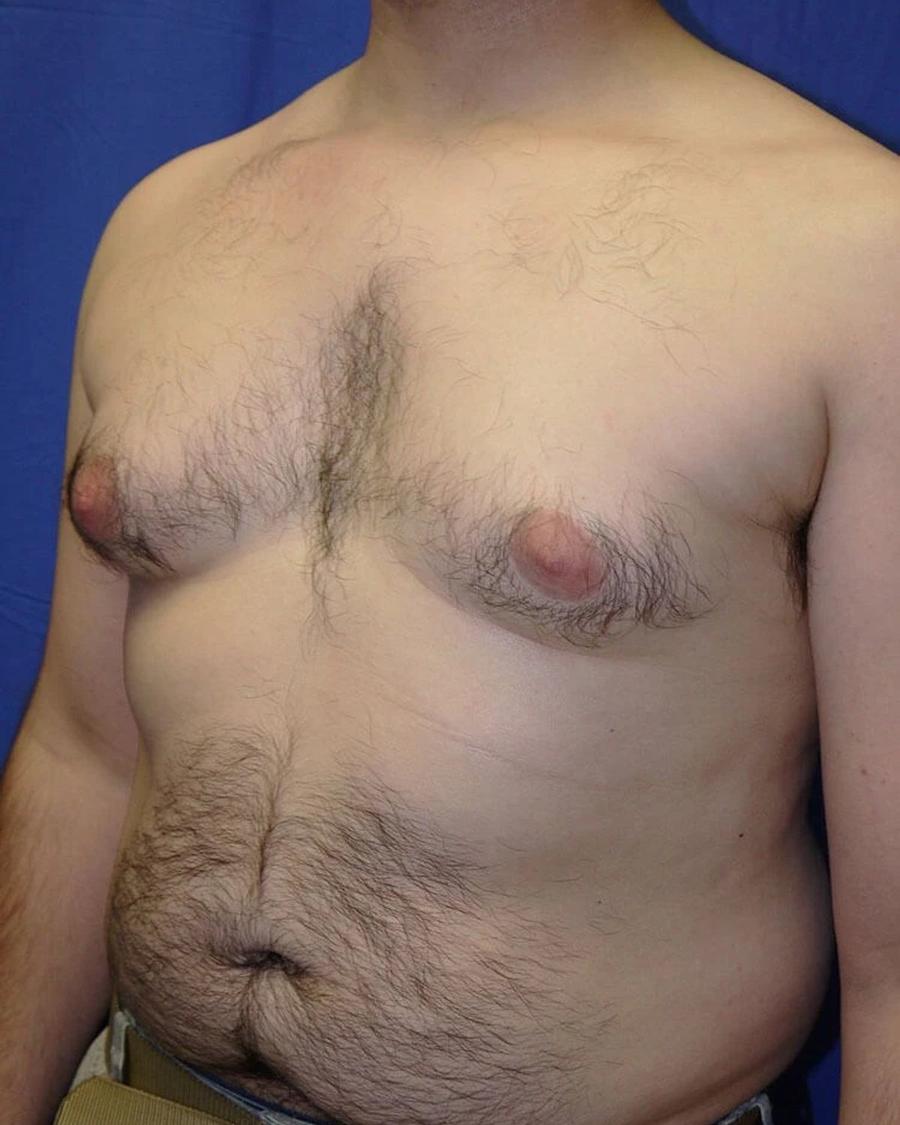 One-Stitch Gynecomastia before