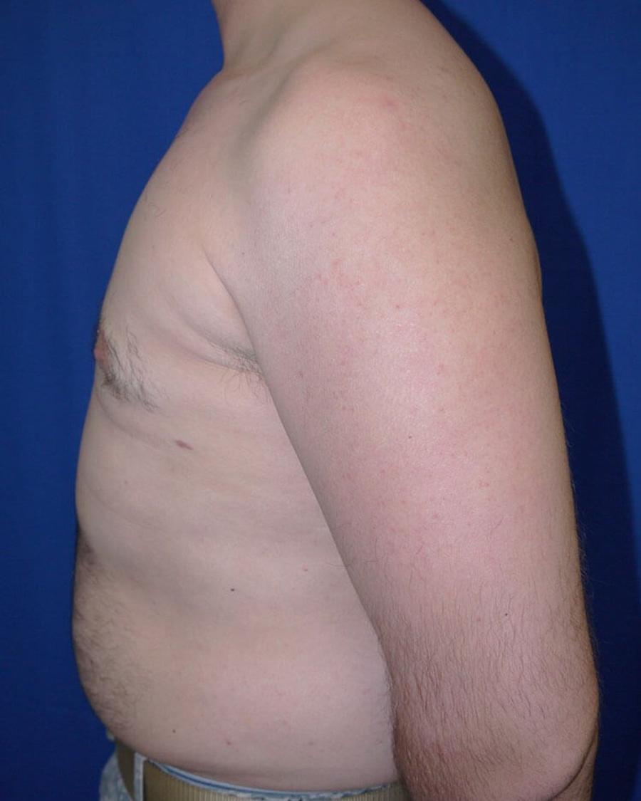 One-Stitch Gynecomastia, Right Profile view, after