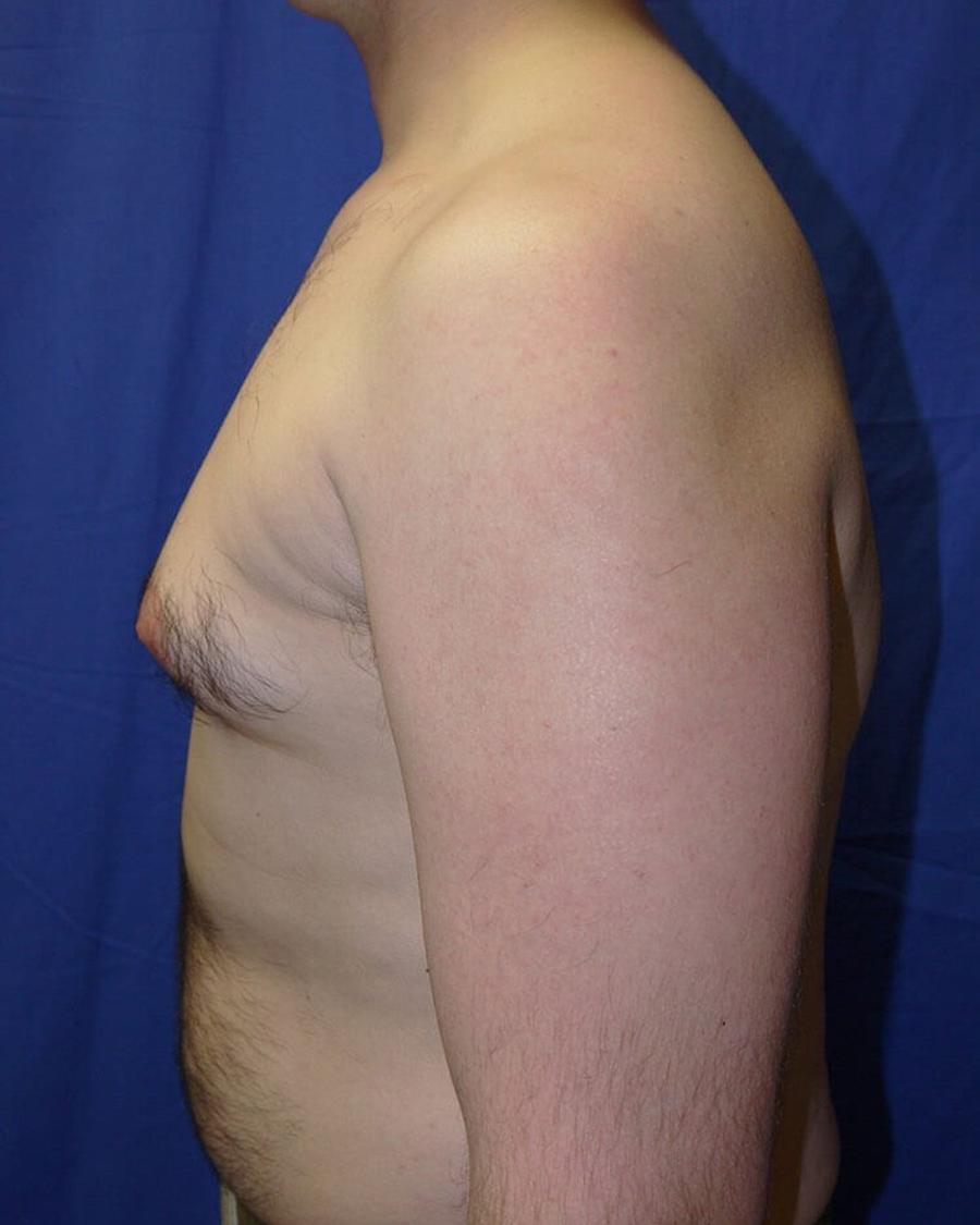 One-Stitch Gynecomastia, Right Profile view, before