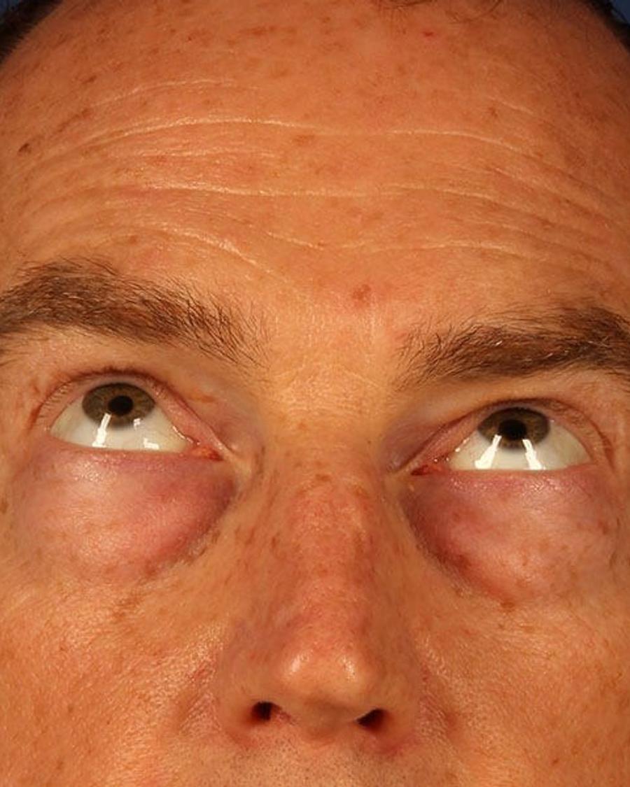 Before Eyelid Surgery
