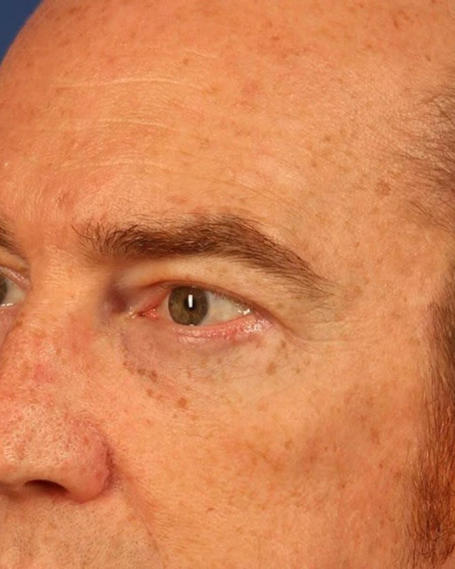 Eyelid Surgery, Oblique Right view, after
