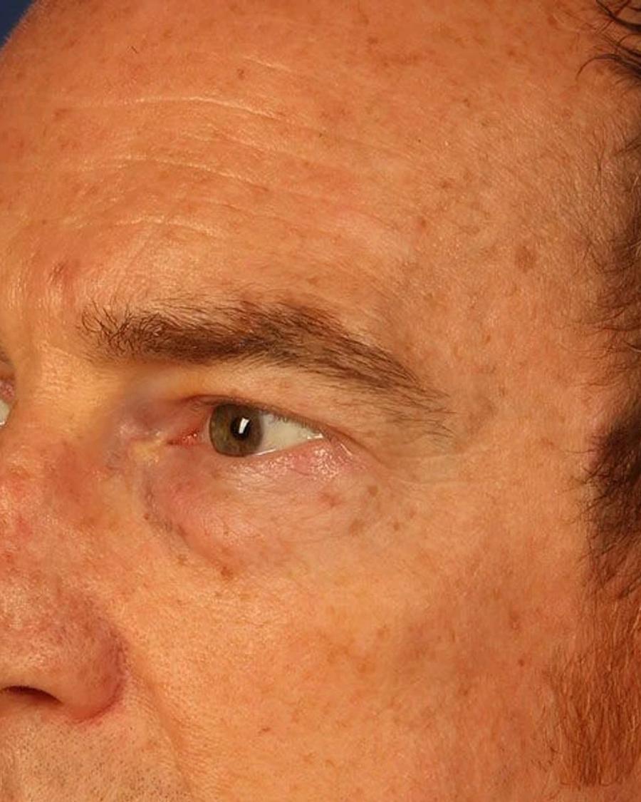 Eyelid Surgery, Oblique Right view, before