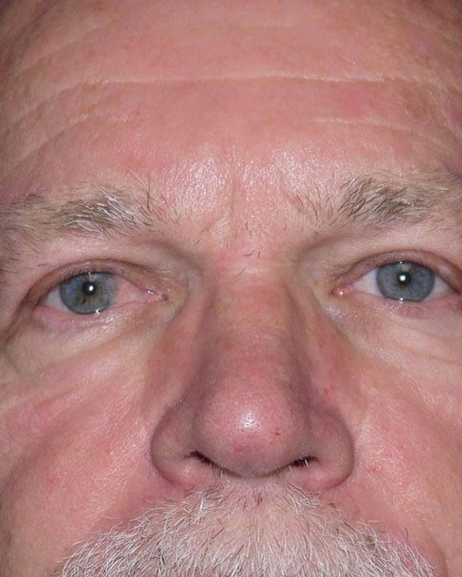 Eyelid Surgery after