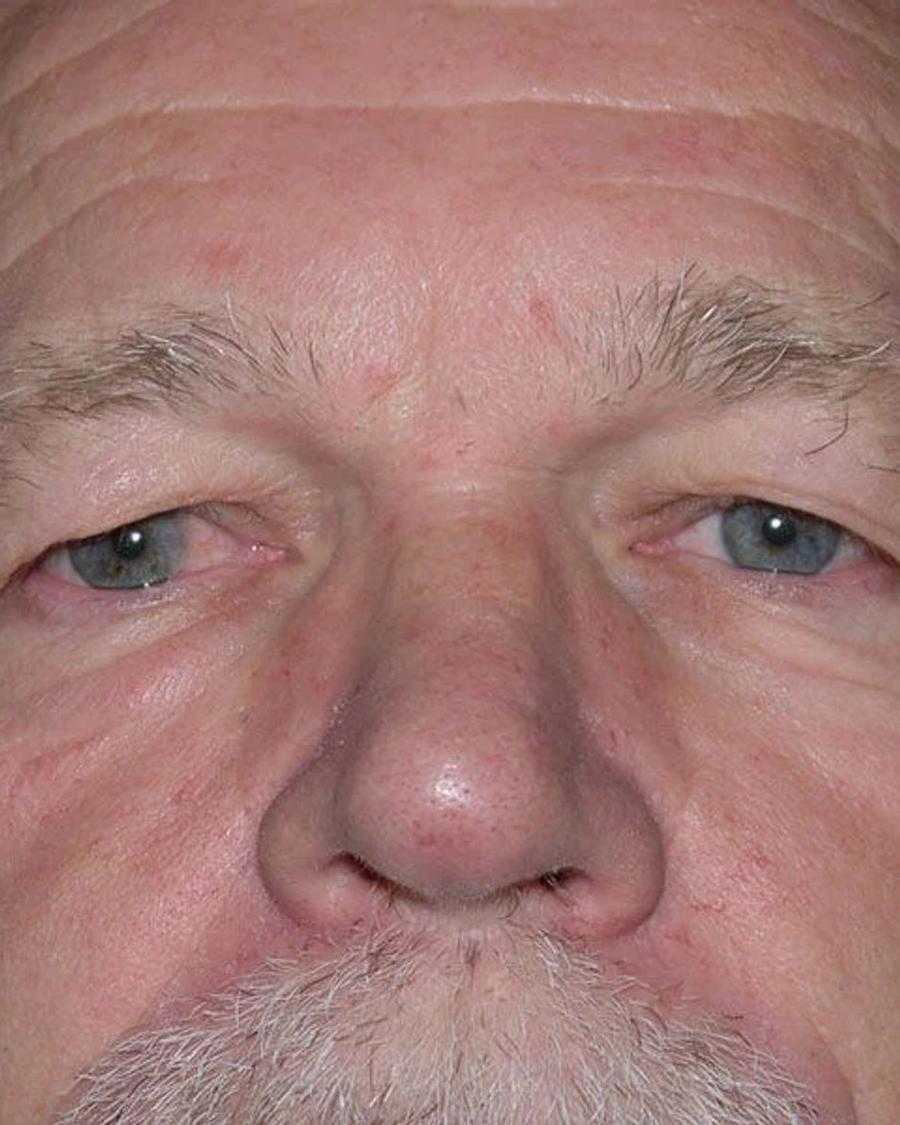 Eyelid Surgery before
