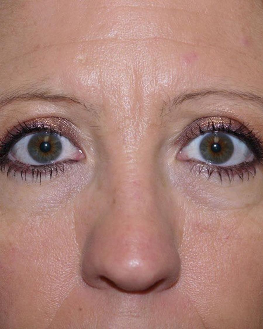 Eyelid Surgery after