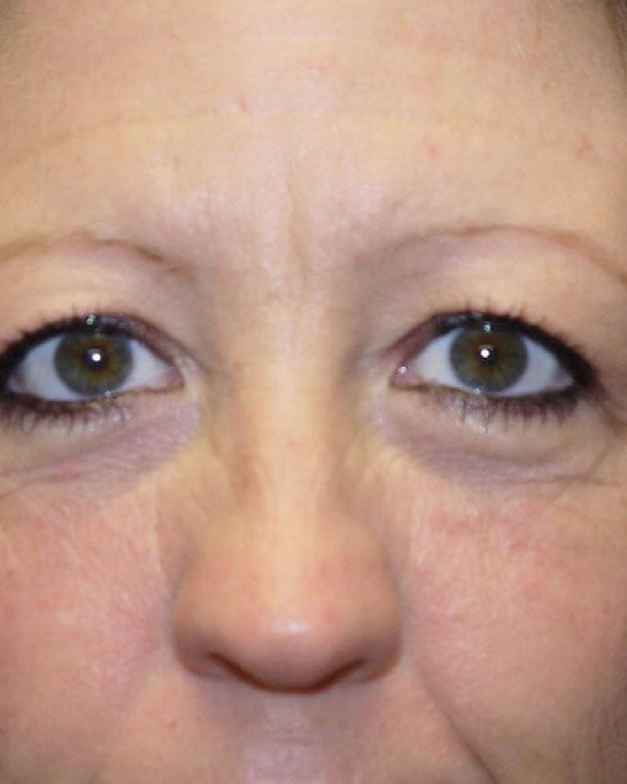 Eyelid Surgery before