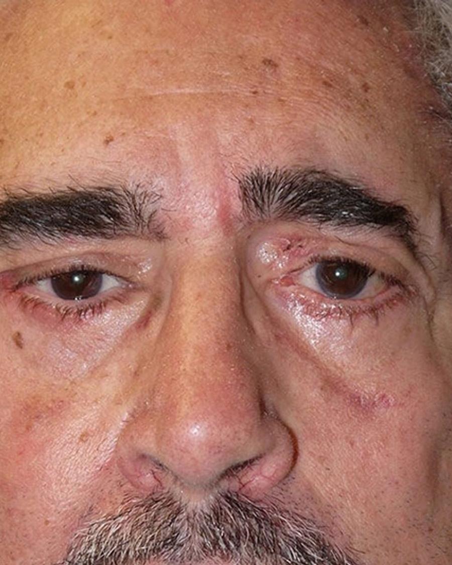 Eyelid Surgery after
