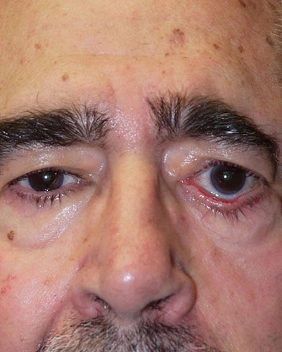 Eyelid Surgery before