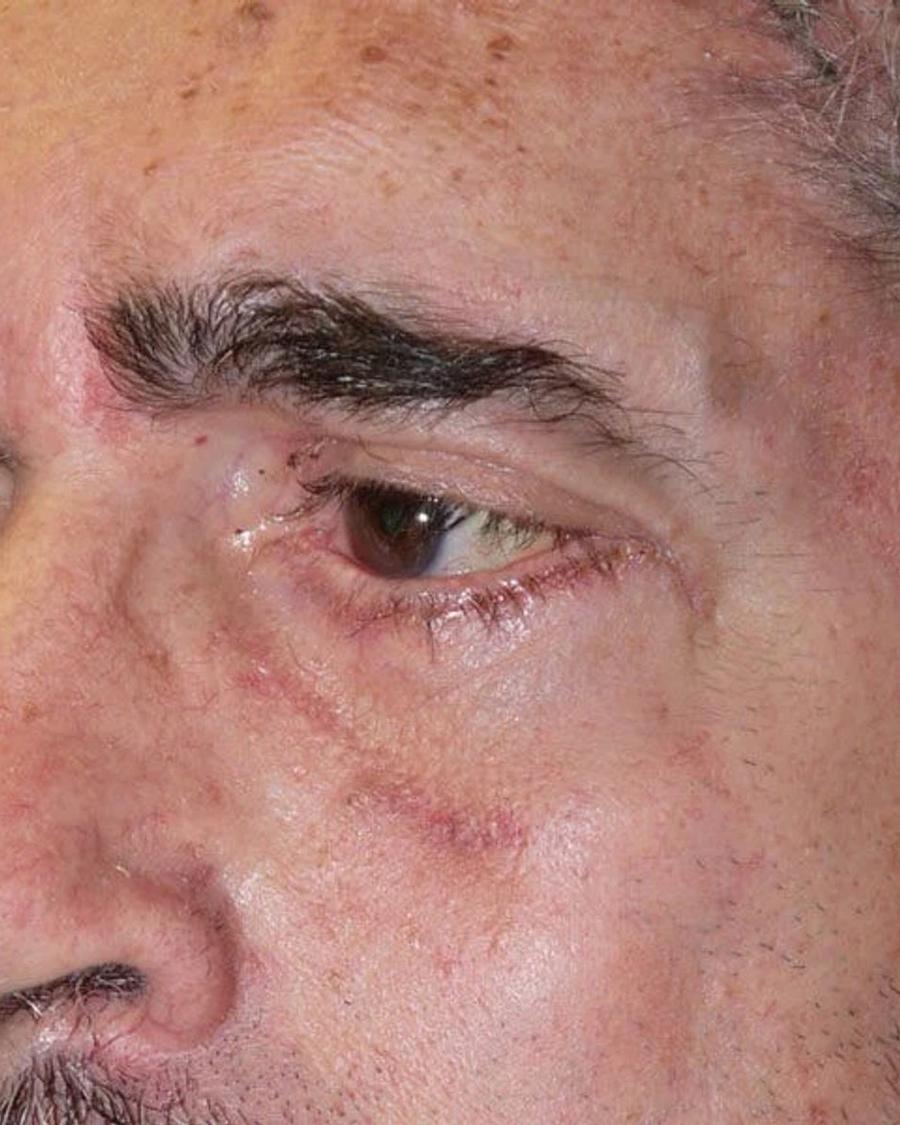 Eyelid Surgery after