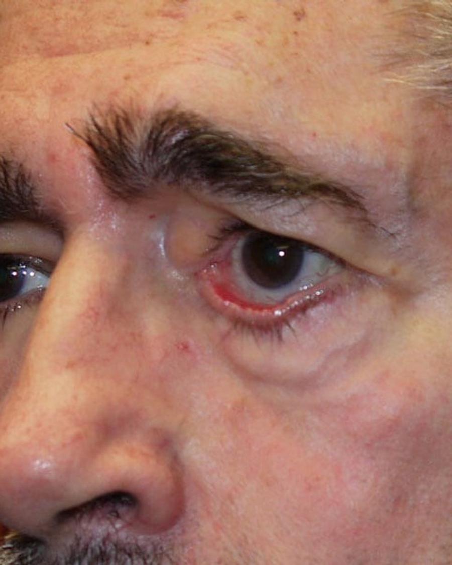 Eyelid Surgery before