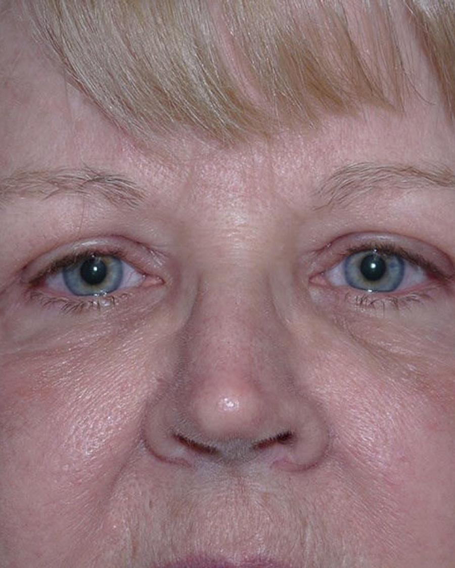 Eyelid Surgery after