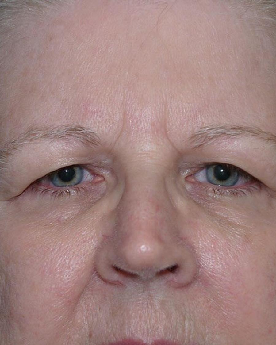 Eyelid Surgery before