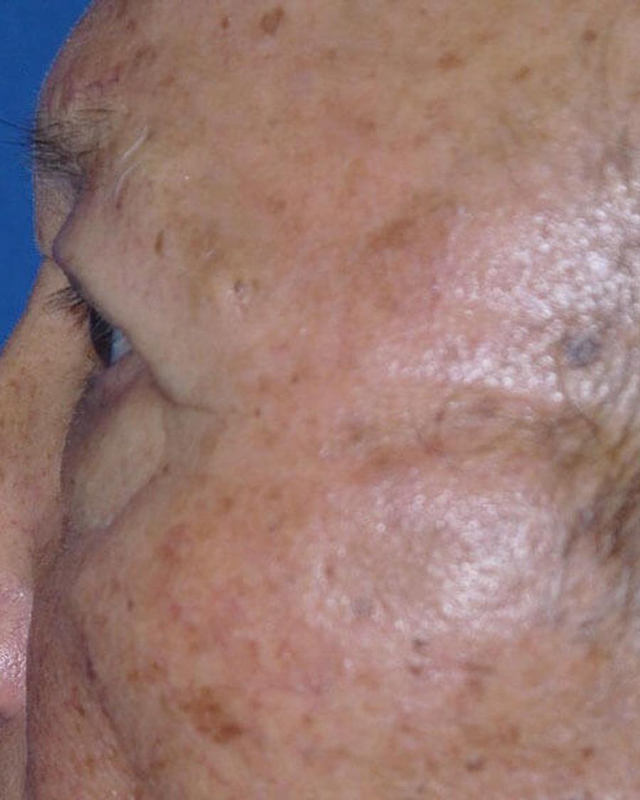 Eyelid Surgery, Left Profile view, after